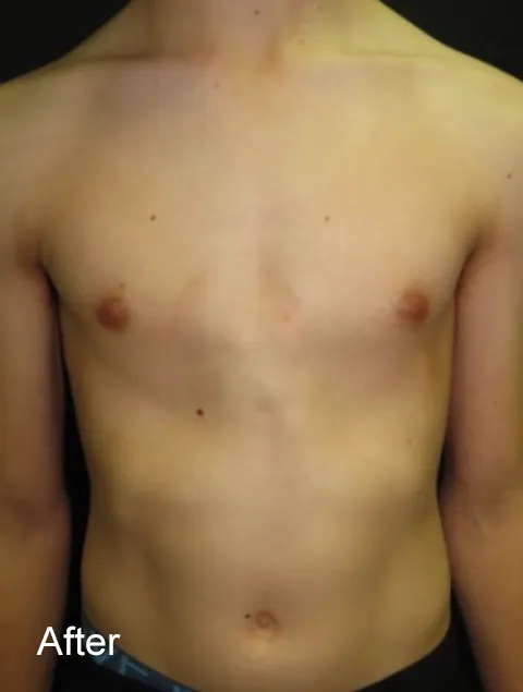 TE after external compressive bracing pectus carinatum