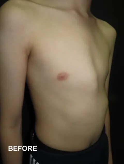Thien before having external compressive bracing for pectus-carinatum