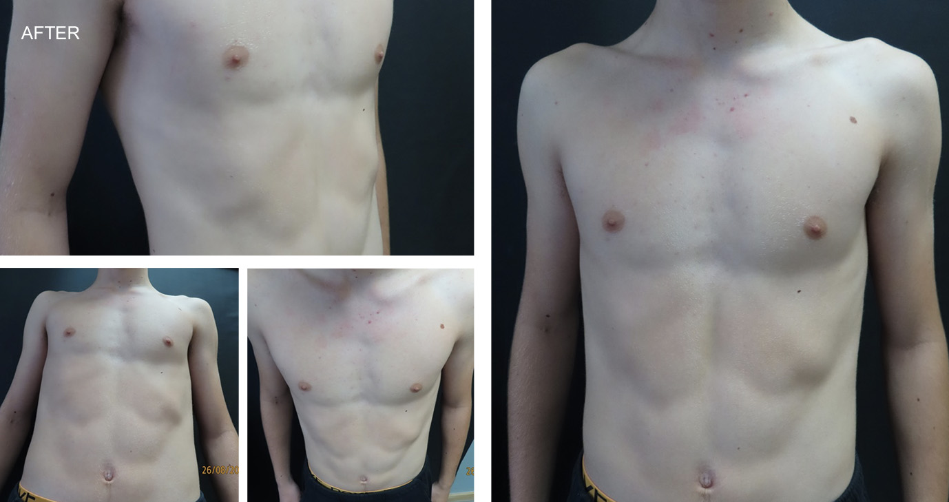 Zach after Vacuum Bell Therapy (VBT) and Rib flare bracing