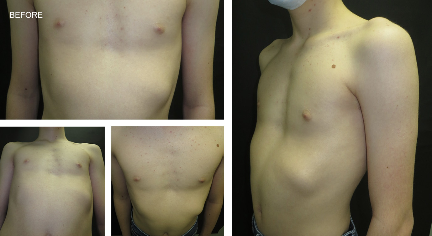Zach before Vacuum Bell Therapy (VBT) and Rib flare bracing