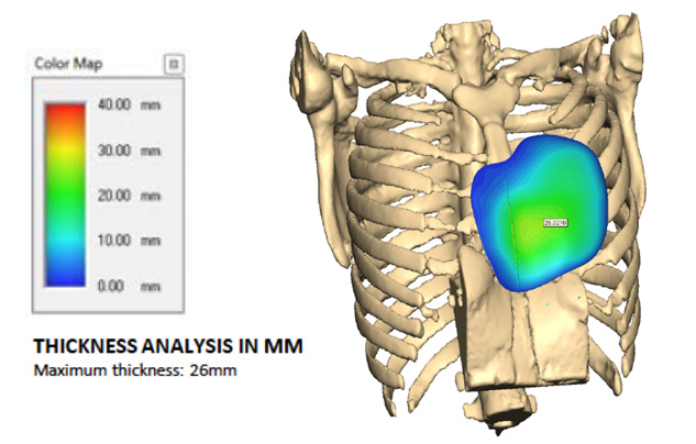 Chest CT reconstruction and 3D implant