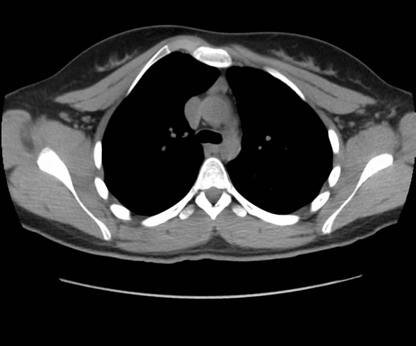 Chest CT Scan