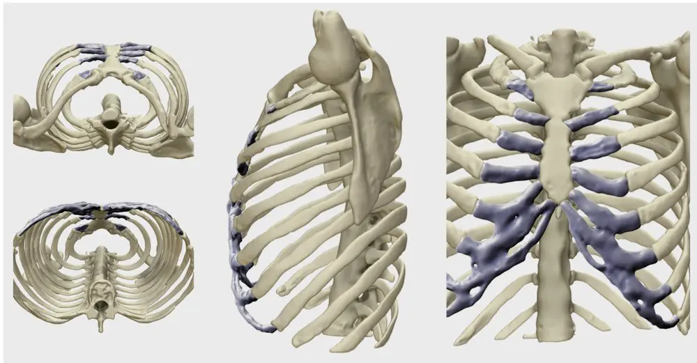 Chest wall anatomy overview diagram