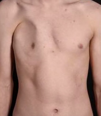 Example of patient with chest wall asymmetry. (A) Patient's