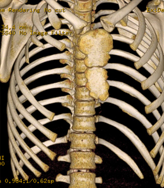 Patients with Poland’s syndrome