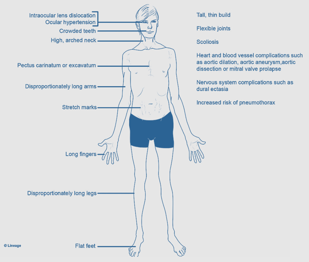 Features of Marfan syndrome
