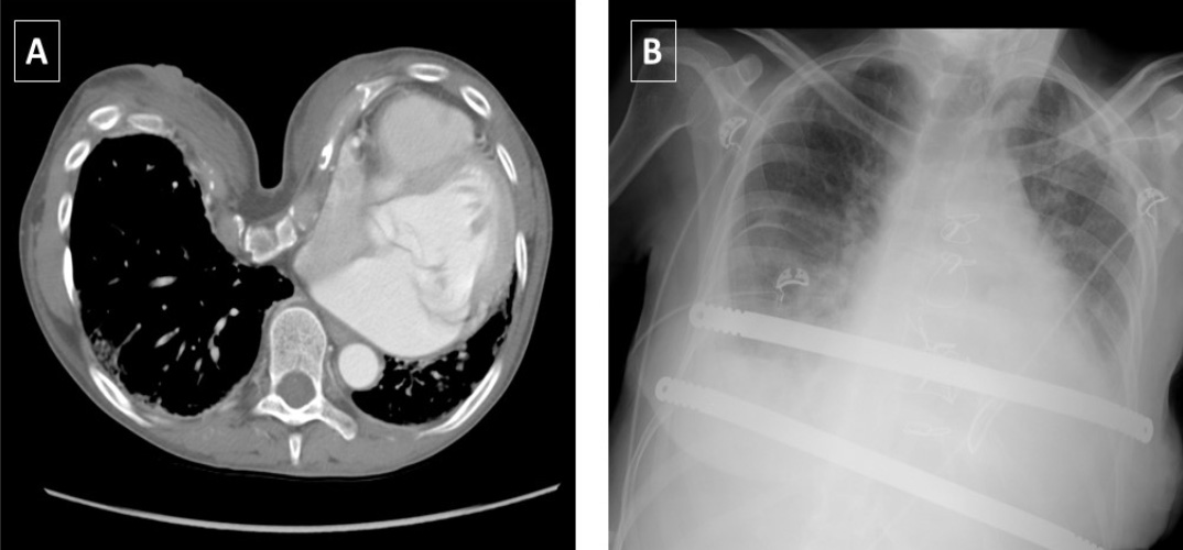 Pre-operative Chest CT image of a severe pectus excavatum deformity