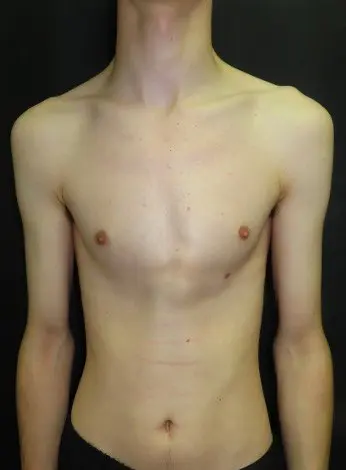 Marfan syndrome — tall, slender habitus with characteristic limb proportions and pectus deformity. Connective tissue assessment and echocardiography are required before any surgical planning.