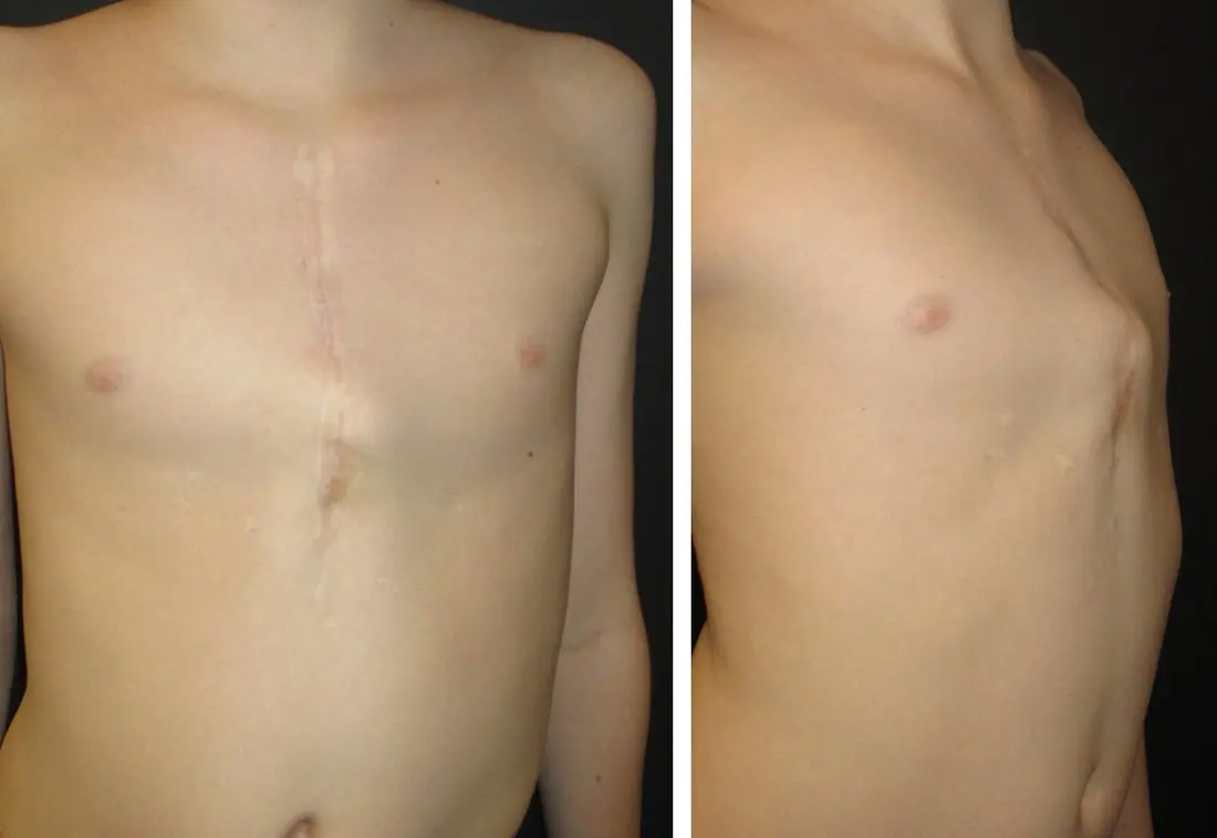 Acquired pectus carinatum following childhood sternotomy for congenital cardiac surgery. Frontal view (left) shows the midline sternotomy scar with anterior sternal protrusion; lateral view (right) demonstrates the characteristic carinatum profile developing after disruption of the anterior chest wall during growth.