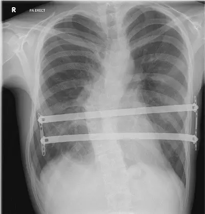 Chest X-ray — double Nuss bar correction in a patient with pectus excavatum and associated scoliosis. Note bilateral bar placement and spinal curvature on the same film.