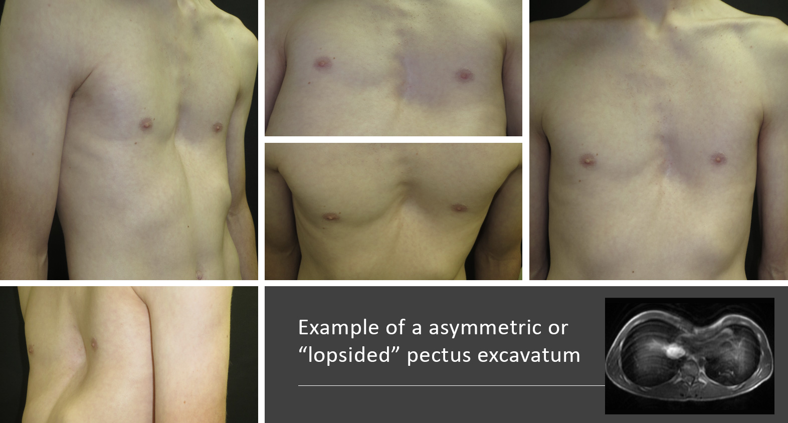 Example of a asymmetric or “lopsided” pectus excavatum