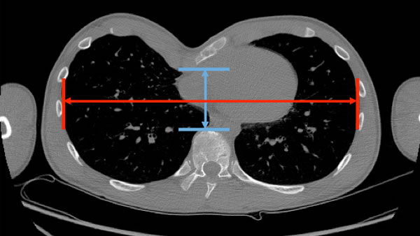 Chest CT scan showing the Haller index used to assess severity of the pectus excavatum