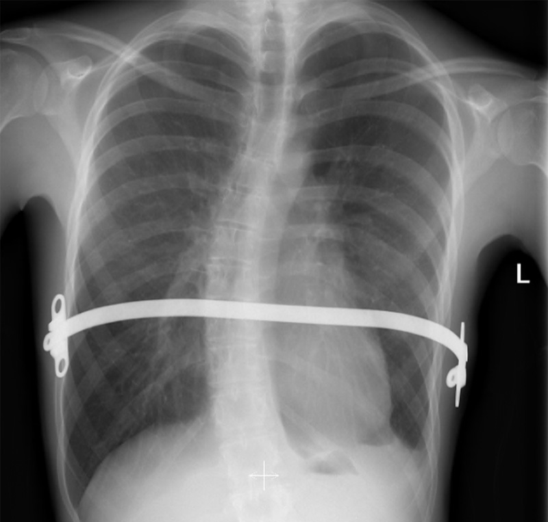 Chest x-ray in patient with an asymmetric severe pectus excavatum corrected with a Nuss procedure