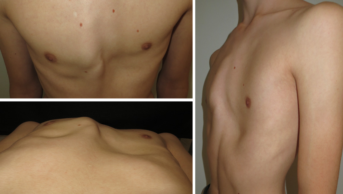 Asymmetric pectus carinatum