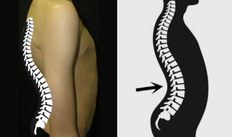 Lumbar Lordosis with pectus carinatum