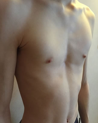 Mild symmetrical Pectus excavatum with a cup shaped deformity and minimal rib flaring