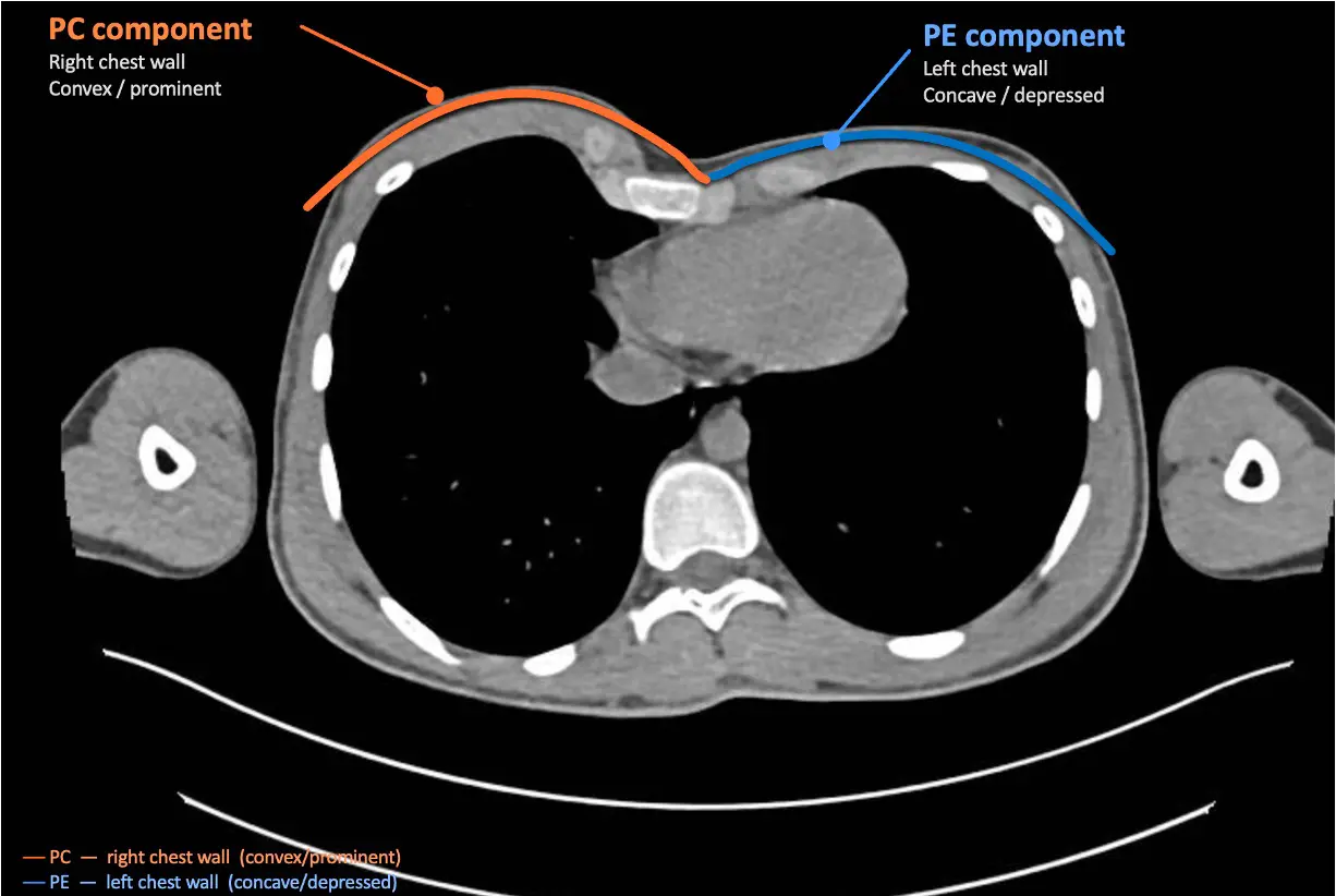 Annotated axial CT chest — PC component right chest wall (orange, convex/prominent); PE component left chest wall (blue, concave/depressed)