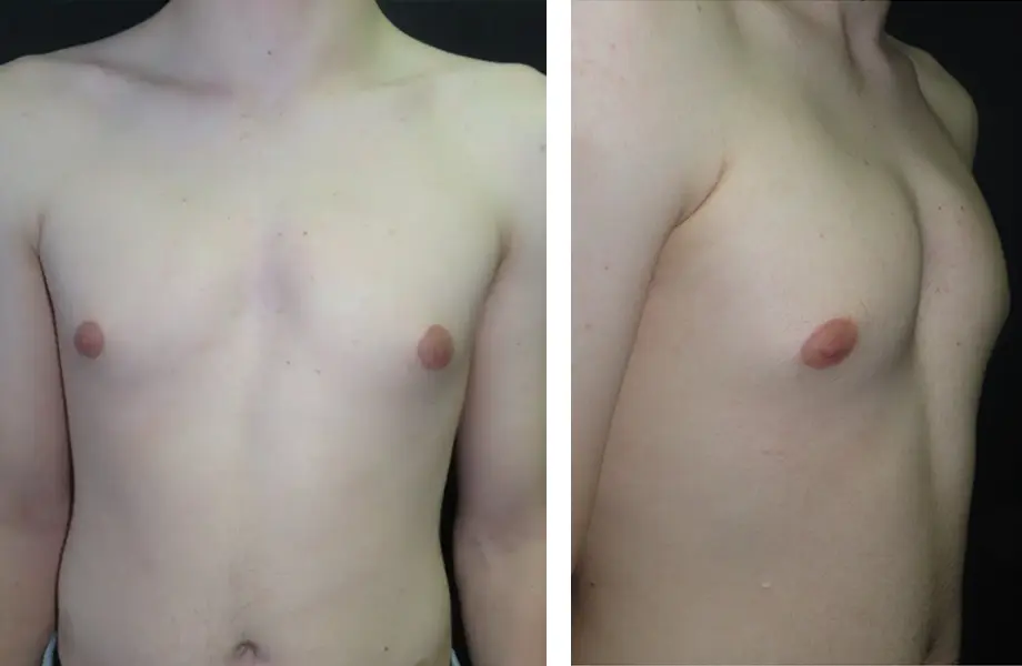 Horseshoe PC — bilateral carinatum, frontal and oblique views