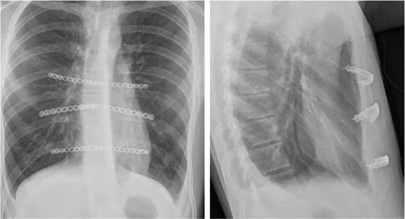 Costal cartilage resection — open correction for PC-dominant mixed pectus