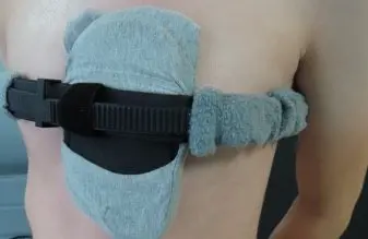External chest wall brace — PC-dominant mixed pectus