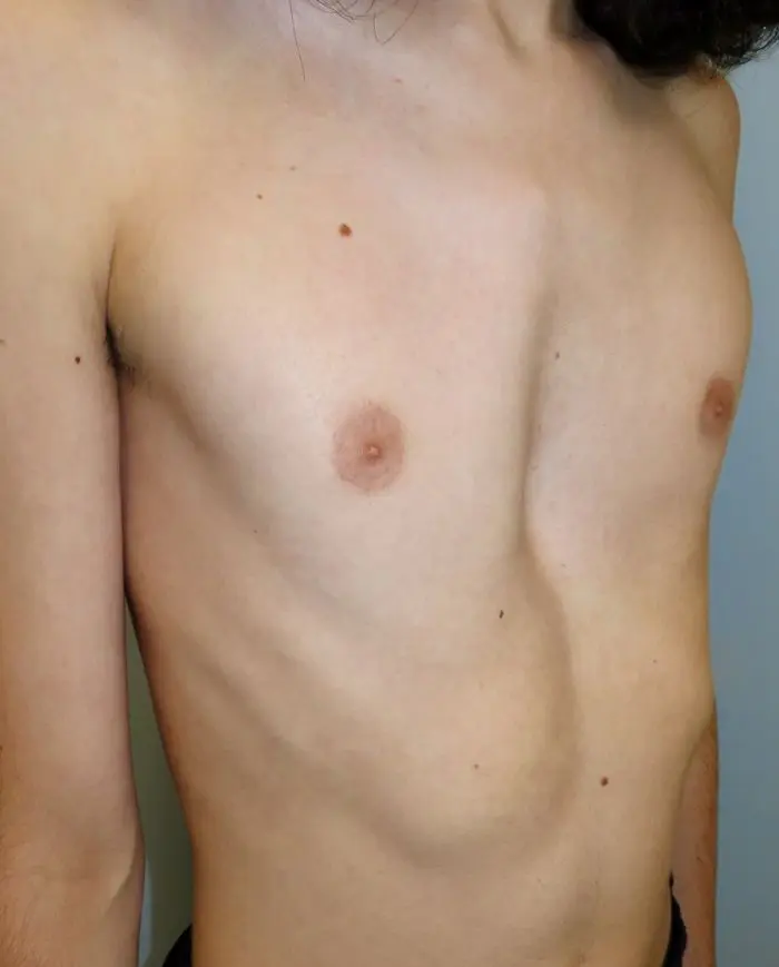 Clinical photograph showing mixed pectus deformity with combined excavatum and carinatum features