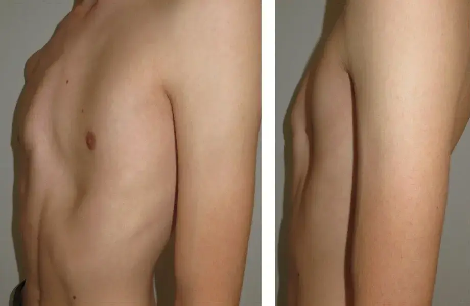 Mixed pectus — PC-dominant, two lateral views