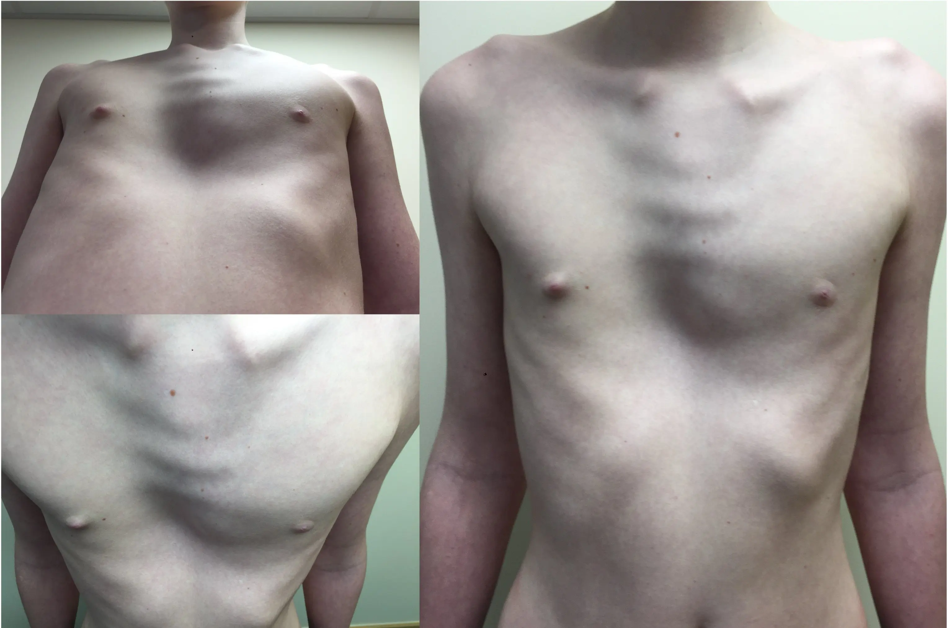 Mixed pectus — PE-dominant, three clinical views