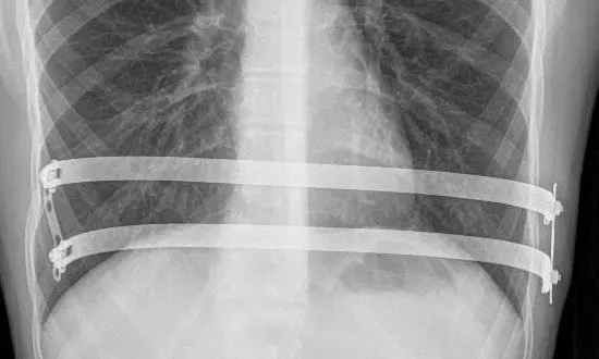 Nuss procedure — minimally invasive bar correction for PE-dominant mixed pectus