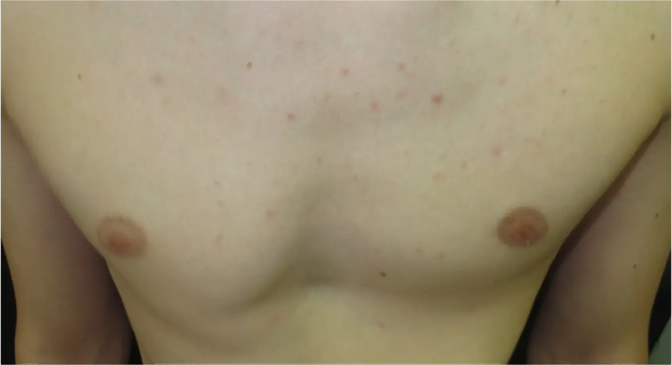 Clinical observation — mixed pectus, younger patient