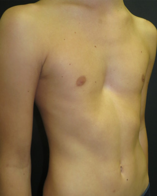 Moderate symmetrical pectus excavatum with more of a saucer shaped deformity and minimal rib flaring