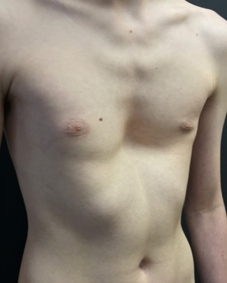 Moderate symmetrical pectus excavatum with more of a cup shaped discrete deformity and moderate rib flaring