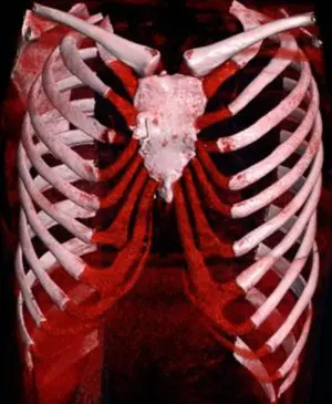 3D CT reconstruction — corrected pectus arcuatum