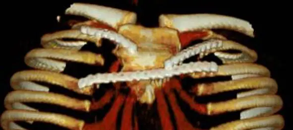 Complex and revision chest wall surgery