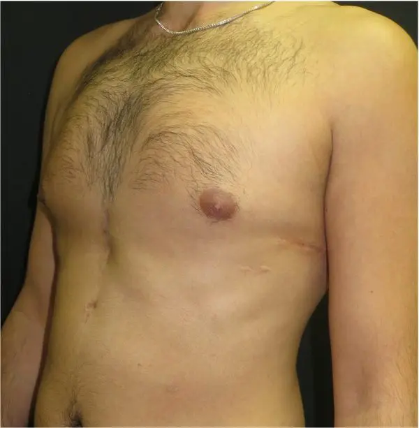 Post-operative result — custom chest wall implant for pectus arcuatum