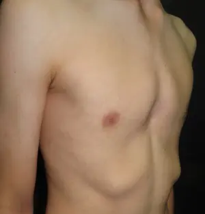 Horseshoe pectus — bilateral carinatum with apparent central depression