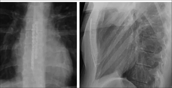 Hybrid chest wall correction