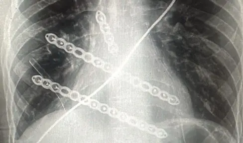 Modified Ravitch procedure — pectus arcuatum correction