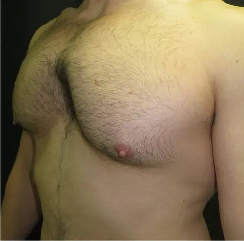 Severe pectus arcuatum — pronounced upper protrusion and lower depression