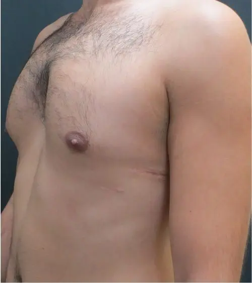 Moderate pectus arcuatum — adult with previous Nuss procedure scar