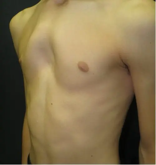 Moderate pectus arcuatum — younger teenager