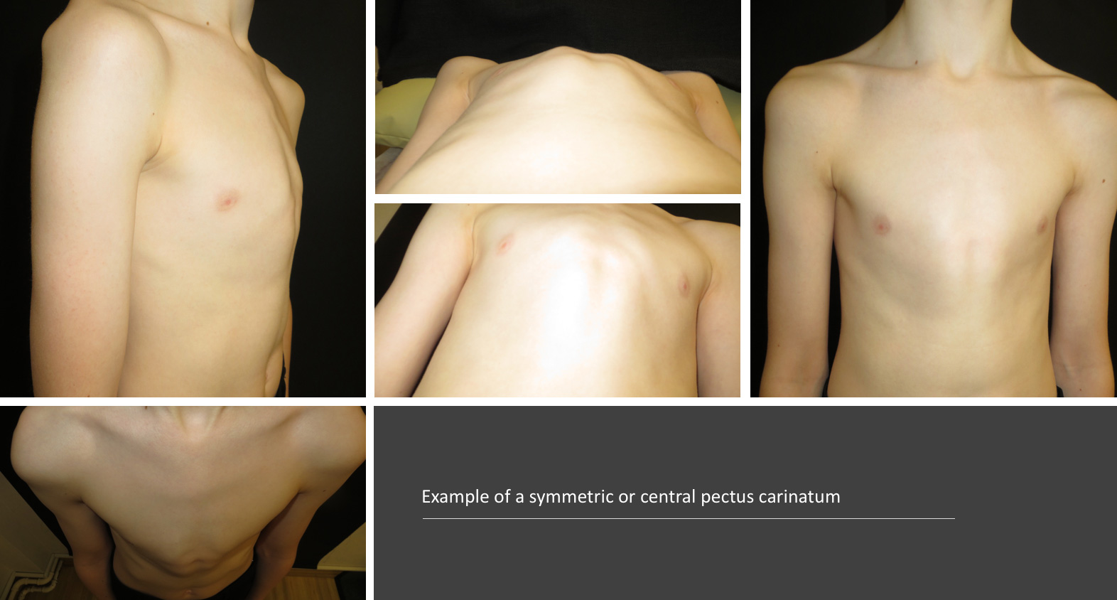 Example of a symmetric or central pectus carinatum