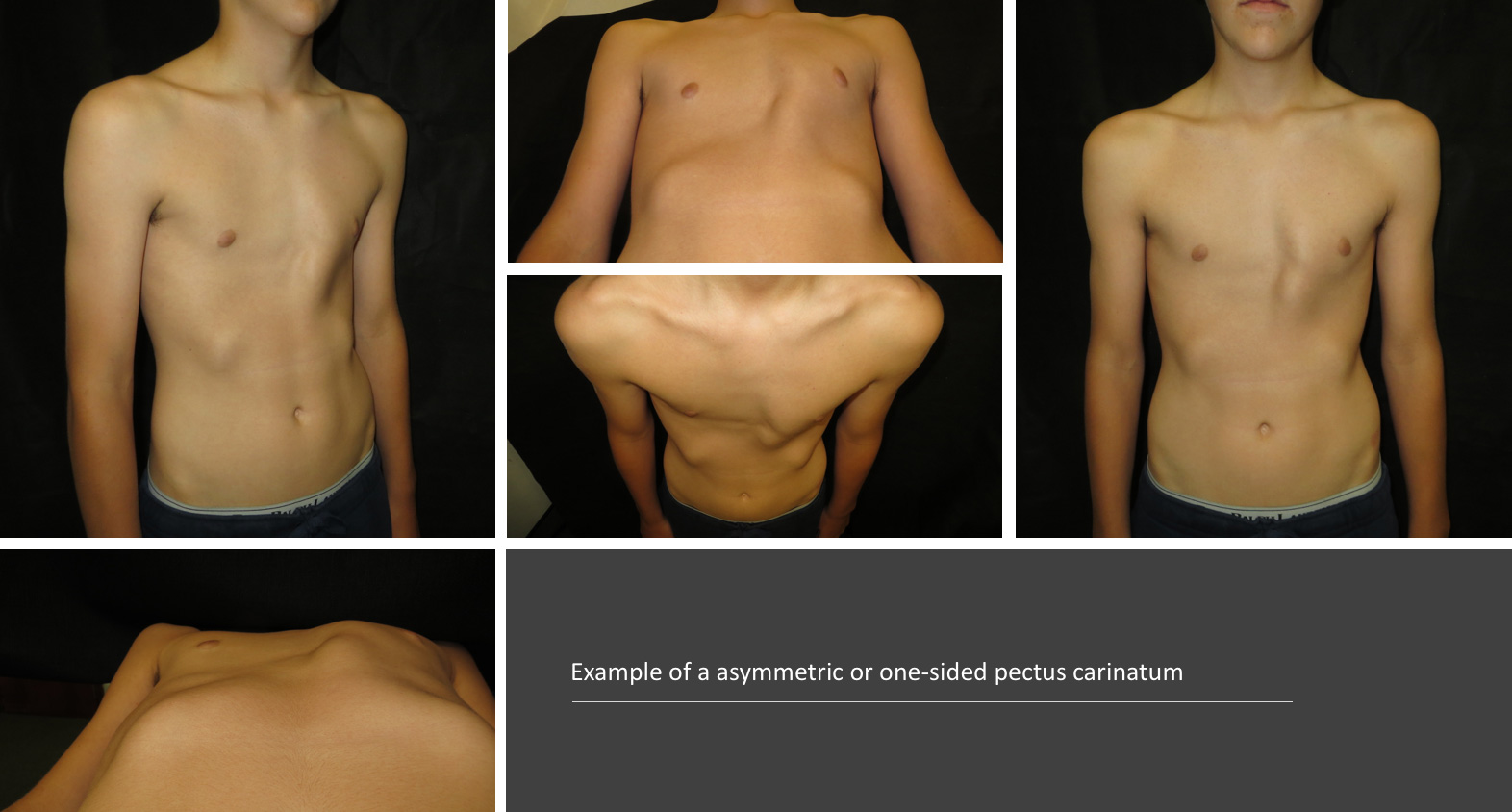 Example of a asymmetric or one-sided pectus carinatum