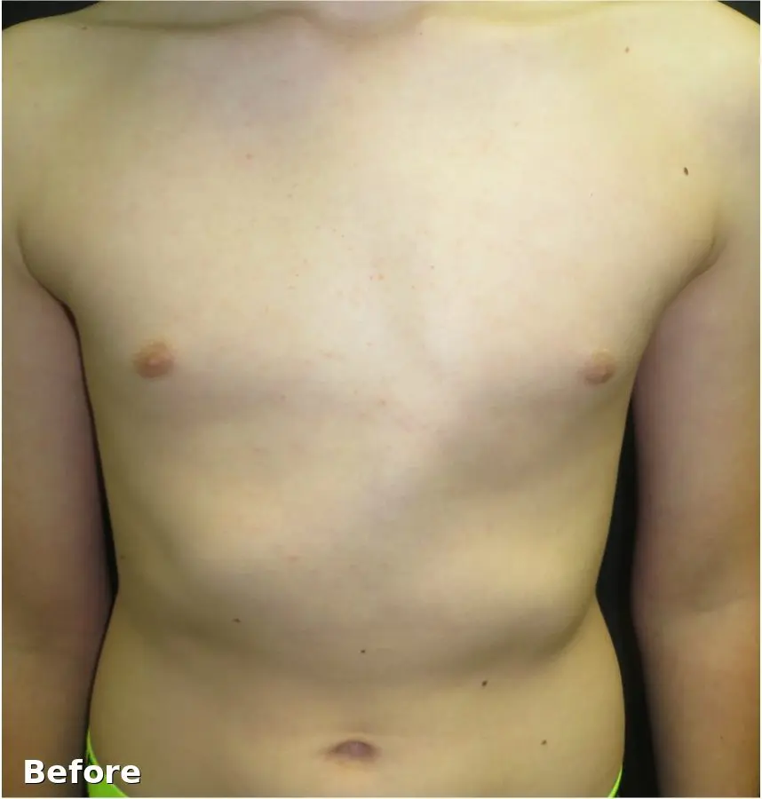Bracing & Rib Flare Brace after