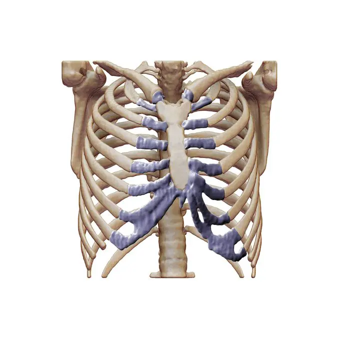 CT 3D reconstruction, anterior view, pectus carinatum