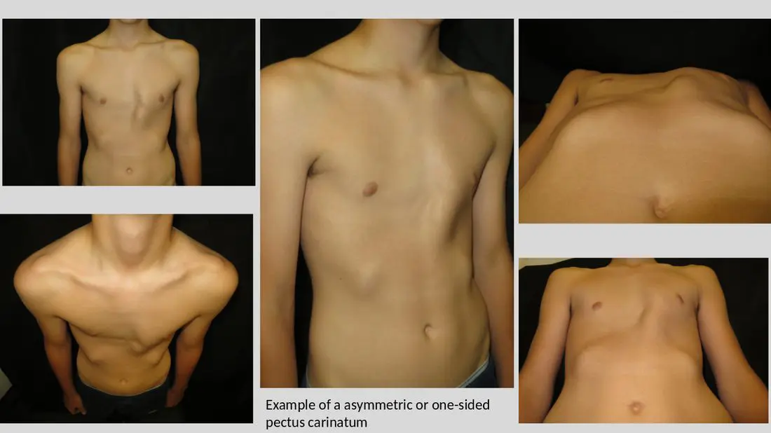 Example of asymmetric or one-sided pectus carinatum — multiple clinical views