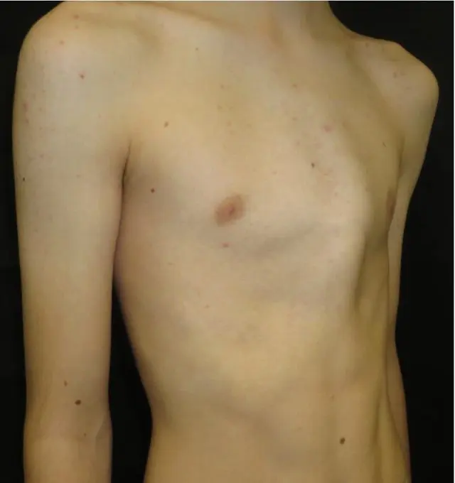 Severe asymmetric pectus carinatum with sternal rotation