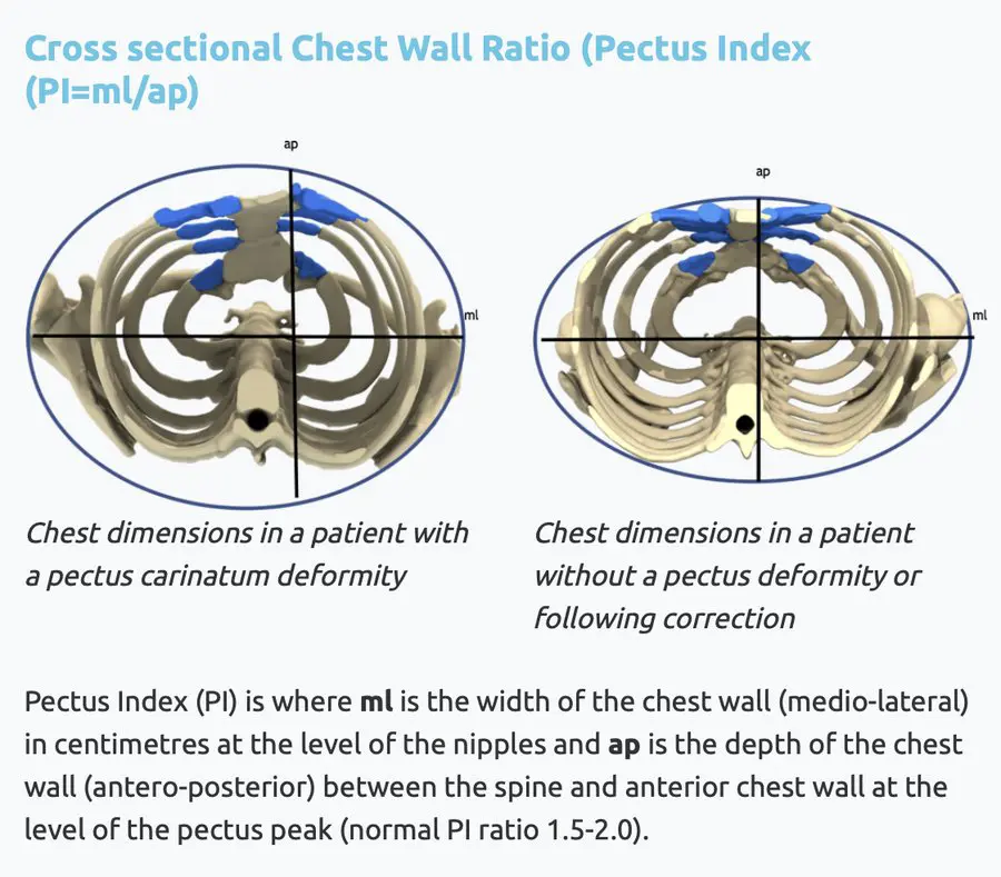 Pectus Index diagram — cross-sectional chest wall ratio showing ml and ap measurements