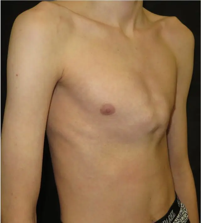 Extreme symmetric pectus carinatum
