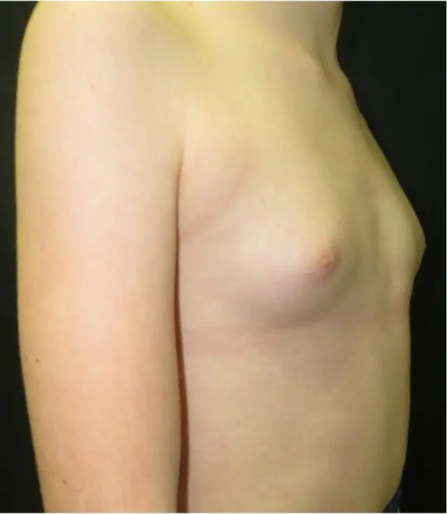 Female pectus carinatum presentation