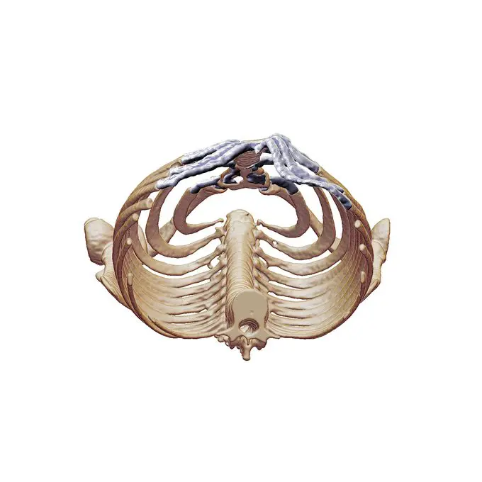 CT 3D reconstruction, left lateral view, pectus carinatum